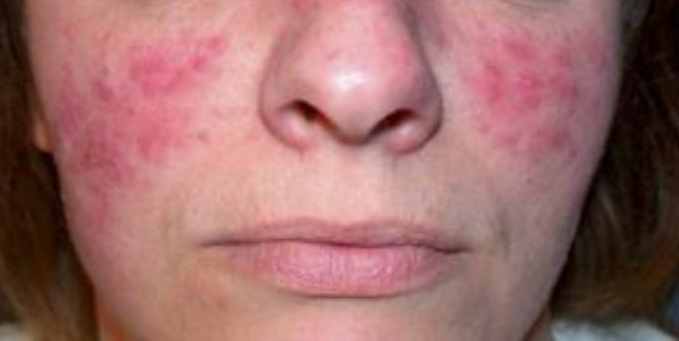 Красные пятна и прыщики на лице: чем опасна розацеа и как с ней бороться?
