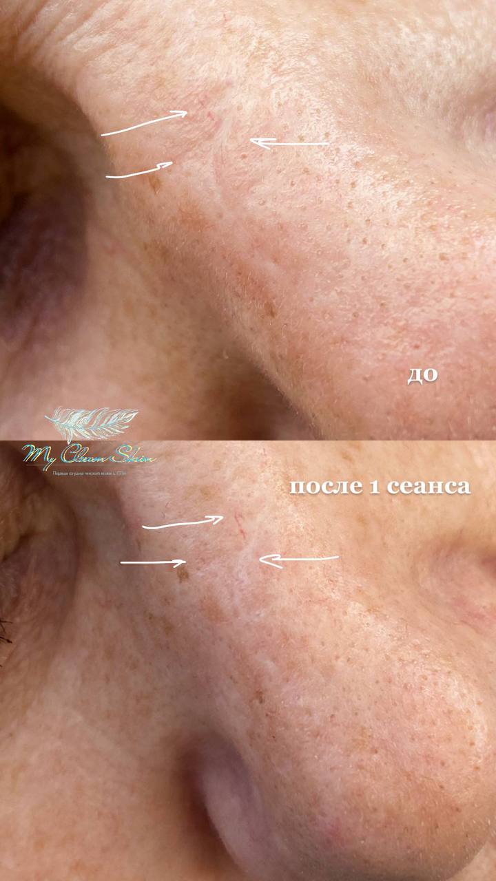 удаление шрама на носу, шлифовка шрама на лице в спб