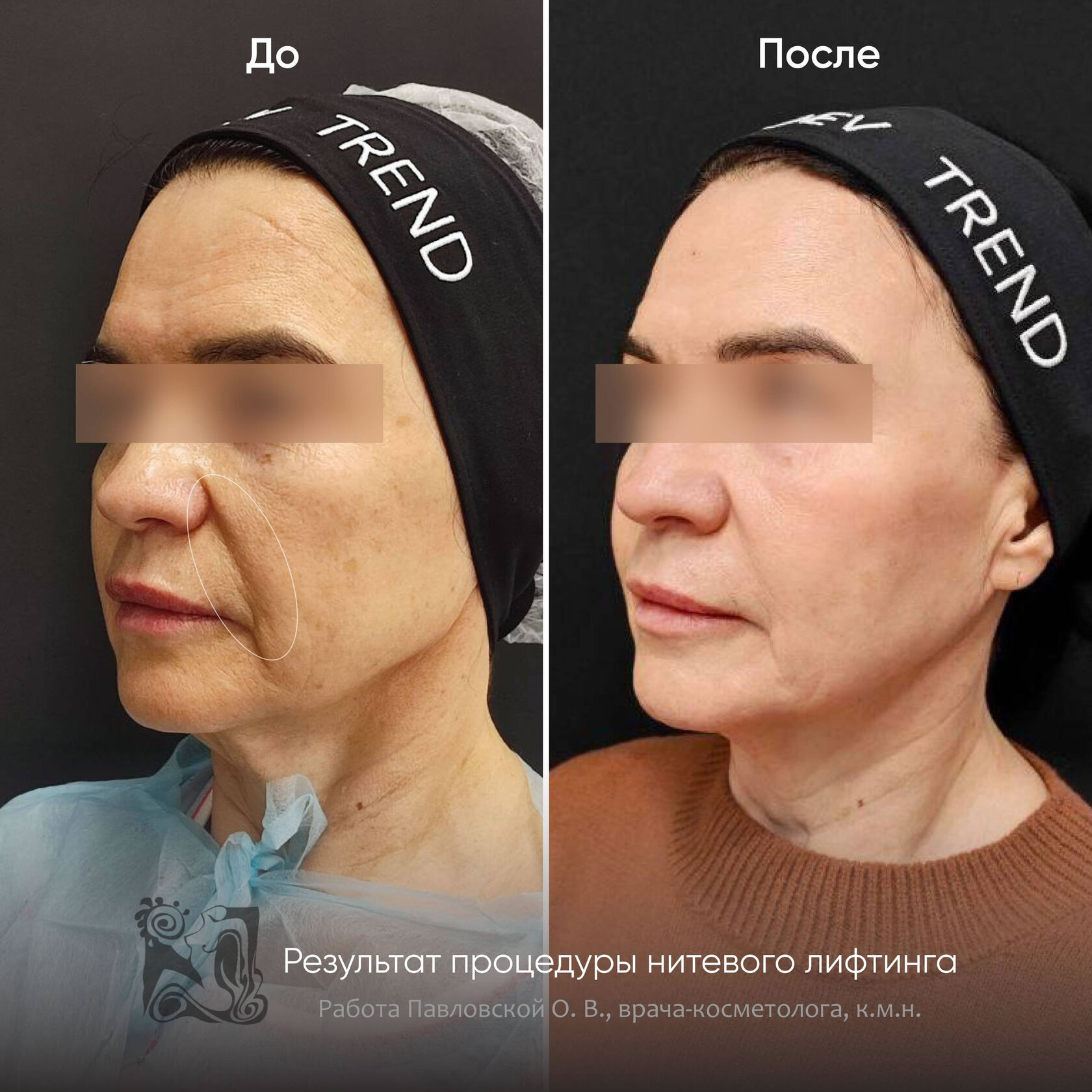 нитевой лифтинг