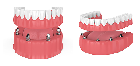 имплантация зубов под ключ 