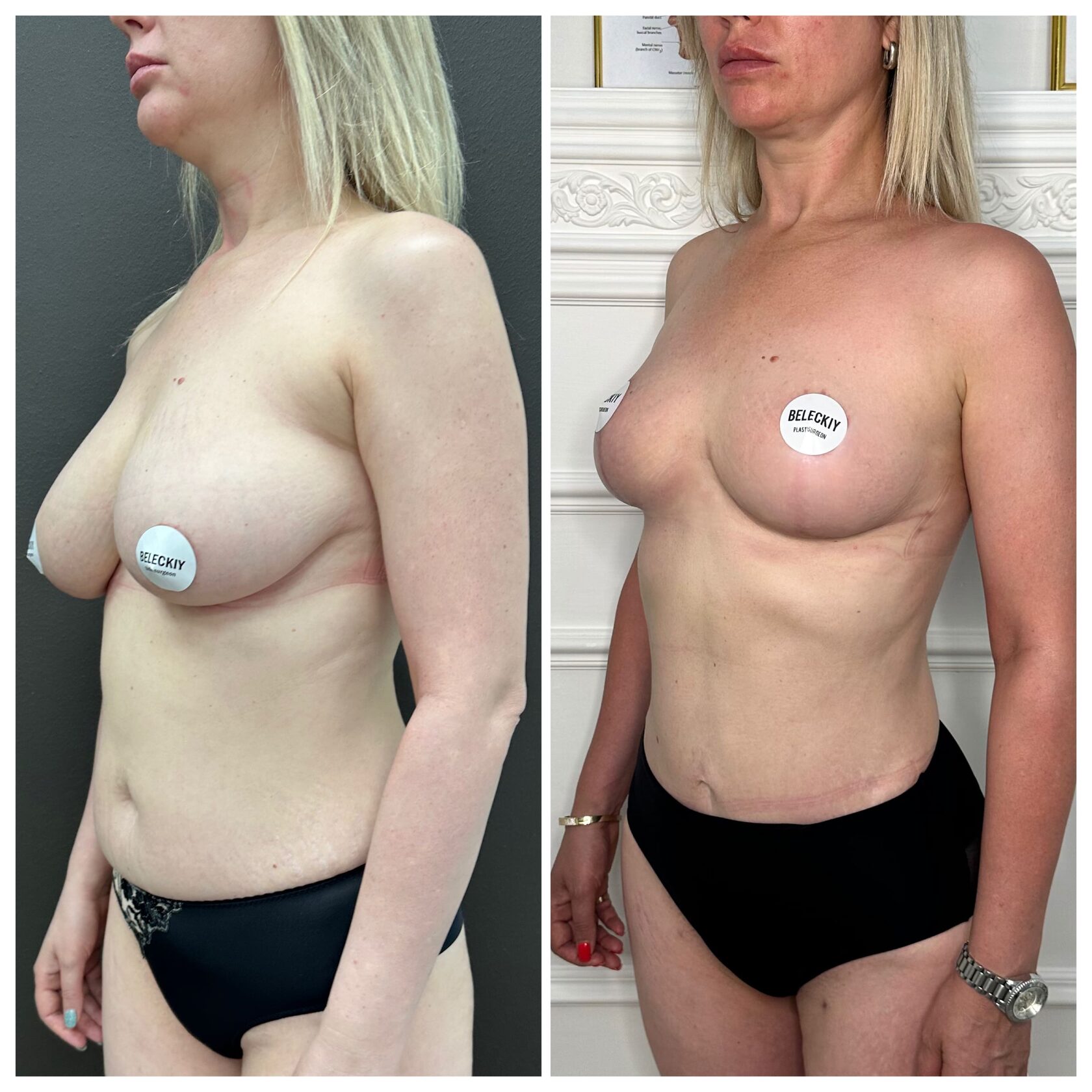липосакции груди у женщин (120) фото