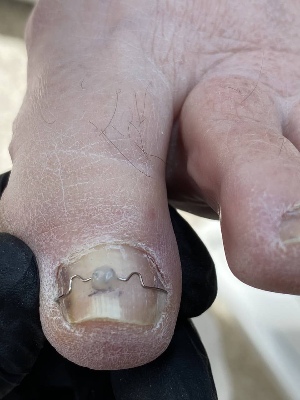 скоба +на ноготь