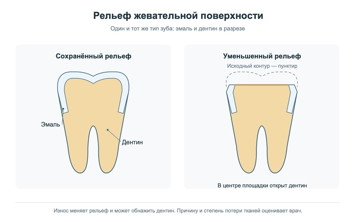 Изменение формы жевательных поверхностей при износе