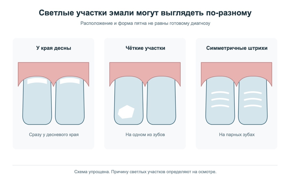 Разные варианты светлых участков на эмали