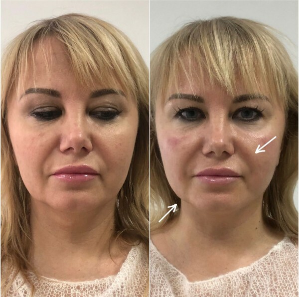 Смас лифтинг цена и отзывы фото