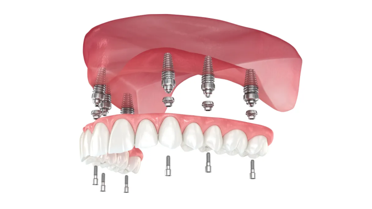  Имплантация зубов системой All-on-6 в Дербенте: этапы, сроки и цена. Стоматология DK
