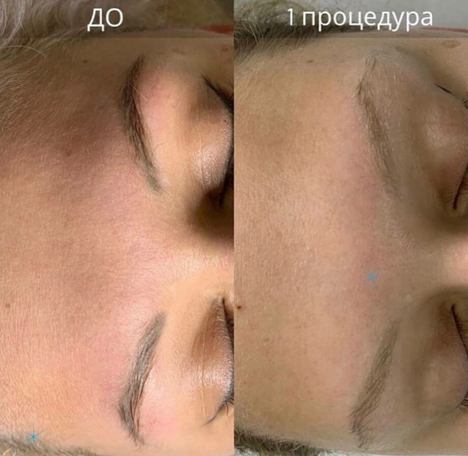 Удаление татуажа бровей лазером фото до и после 1 процедуры
