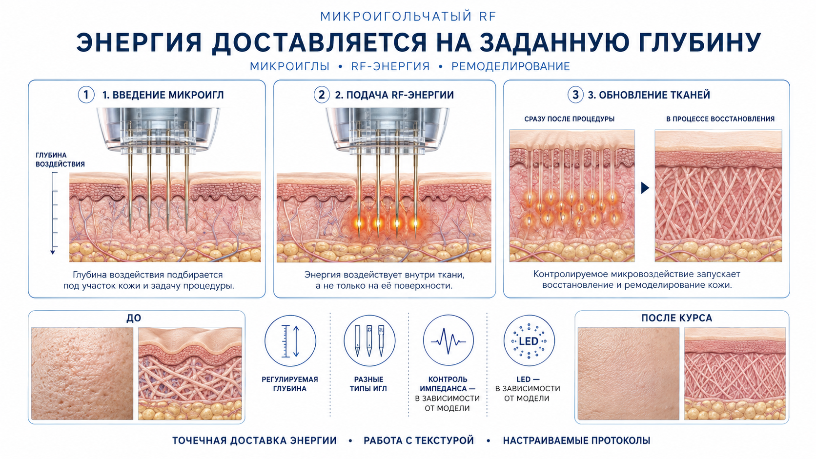 Схема микроигольчатого RF воздействия