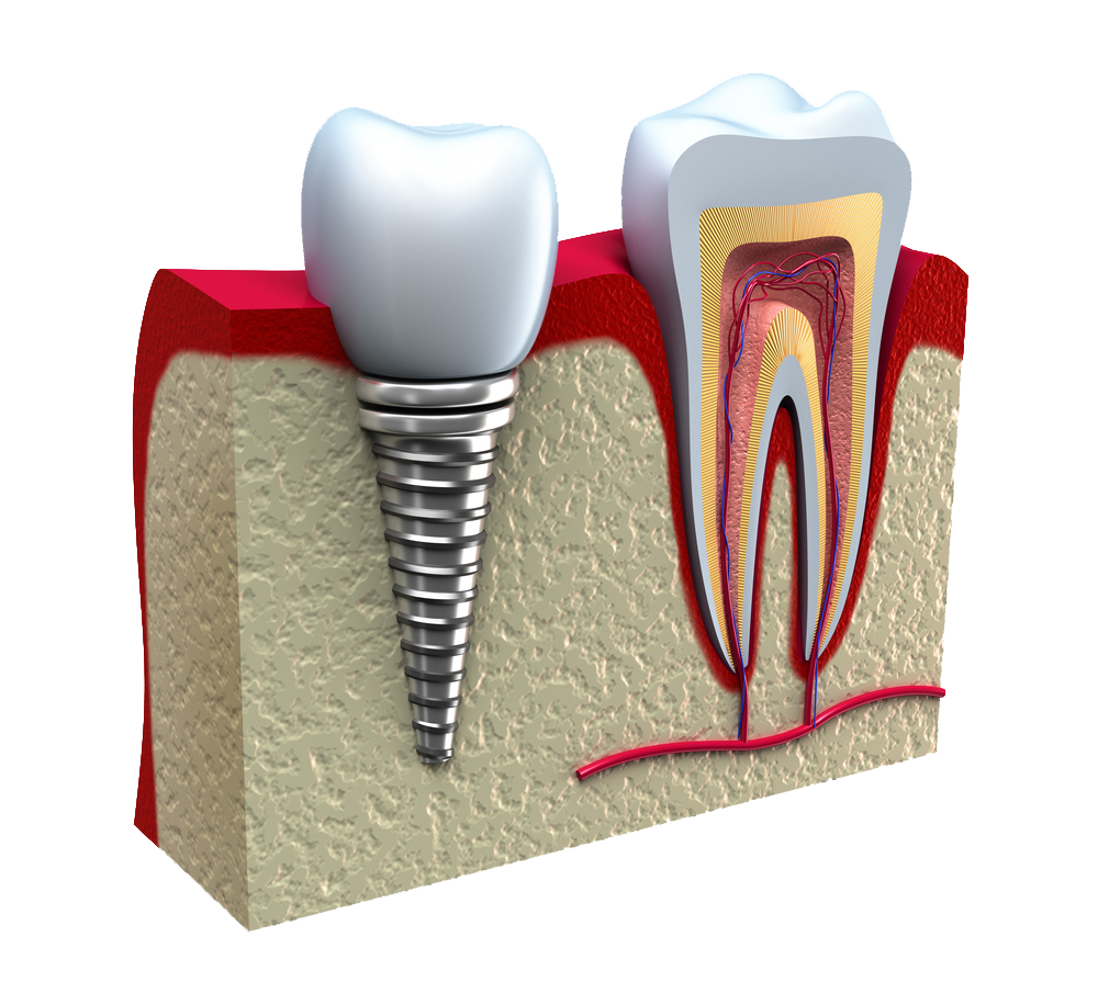 Закаленный зуб. Зубной имплантат. Стоматология имплантация.