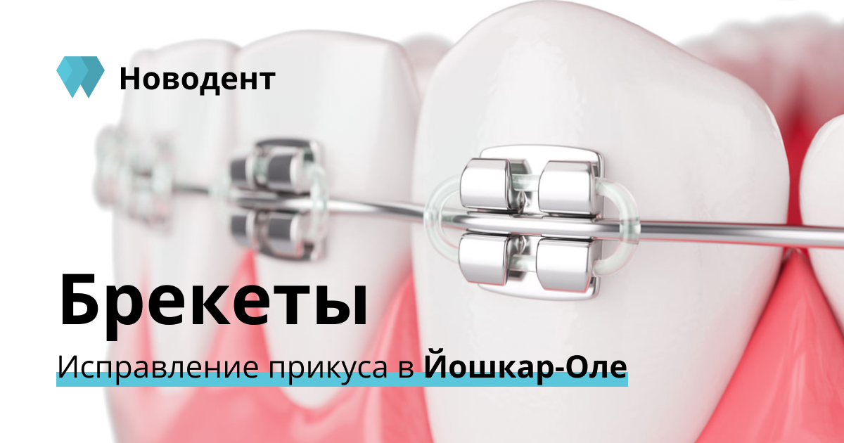 записаться к ортодонту. сколько стоят брекеты в йошкар оле. железные брекеты. сапфировые самолигирующие брекеты. сколько стоят брекеты в йошкар оле.
