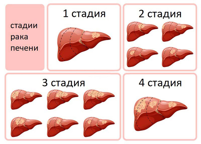 Стадии рака печени прогноз