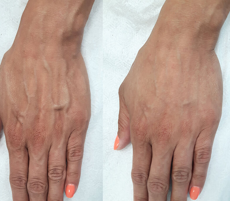 Плазмотерапия кистей рук до и после процедуры