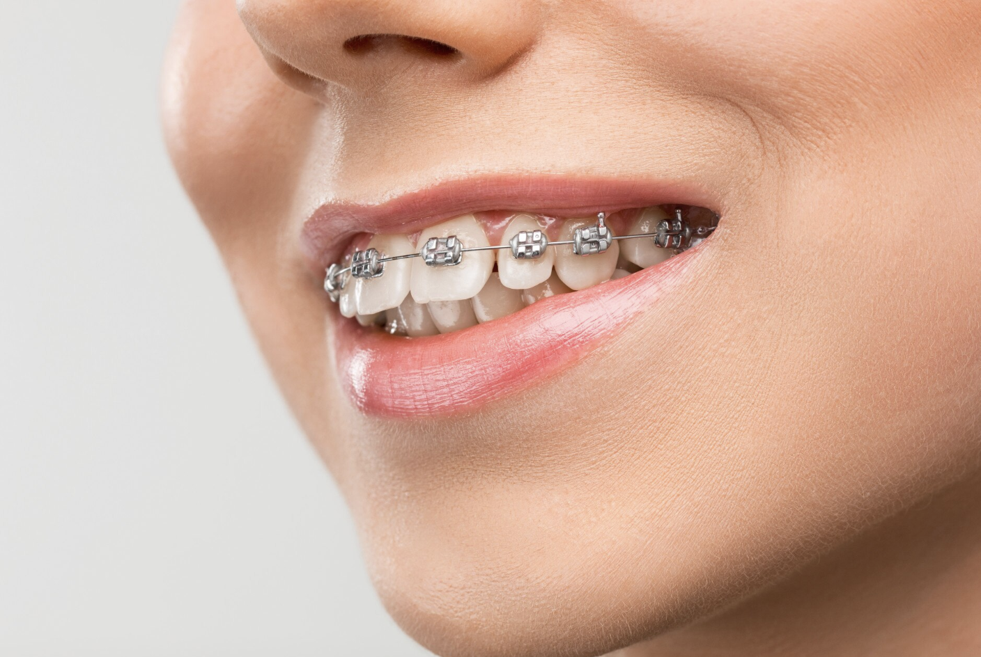 нужно исправить неправильный прикус