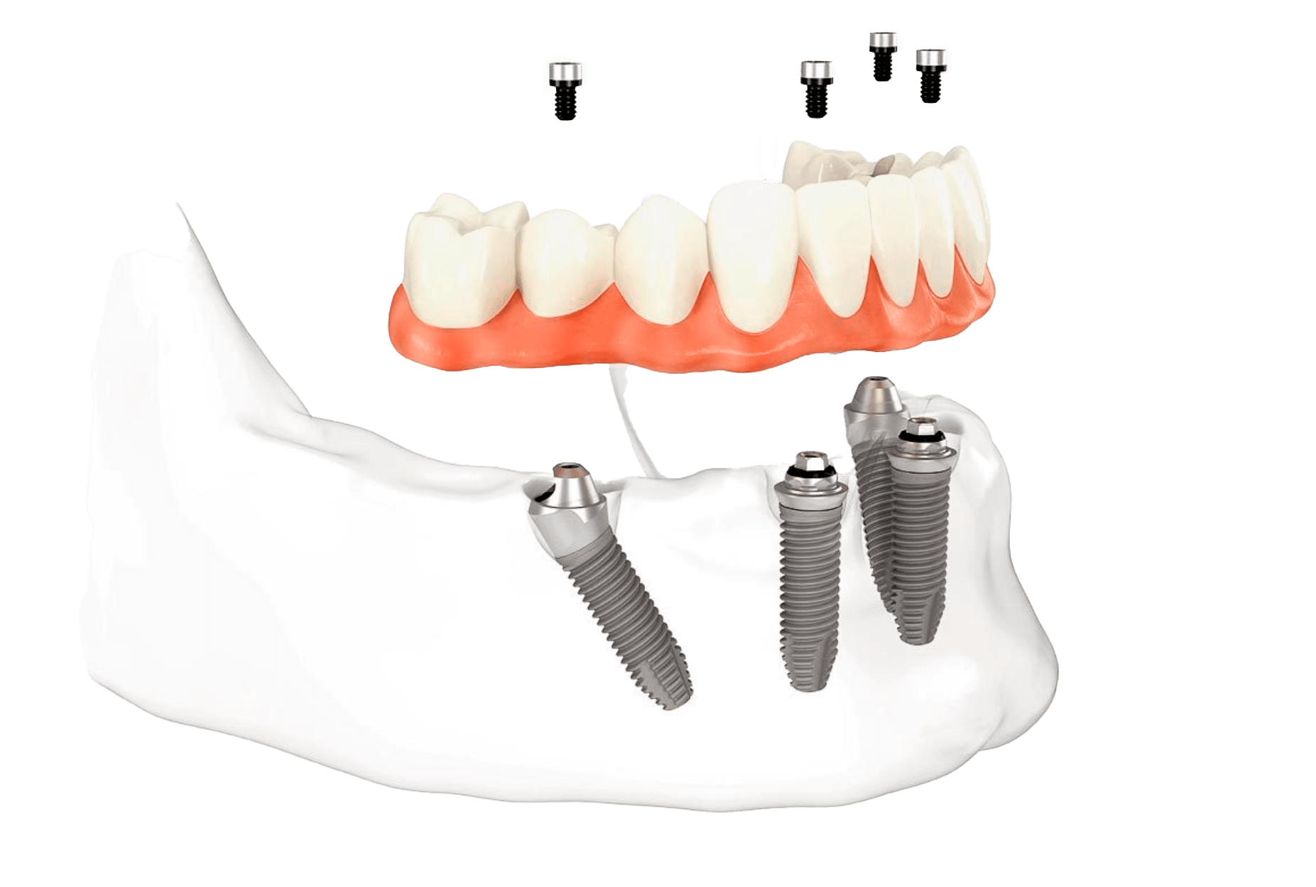 Челюсть на 4 имплантах. All on 4 имплантация Нобель.