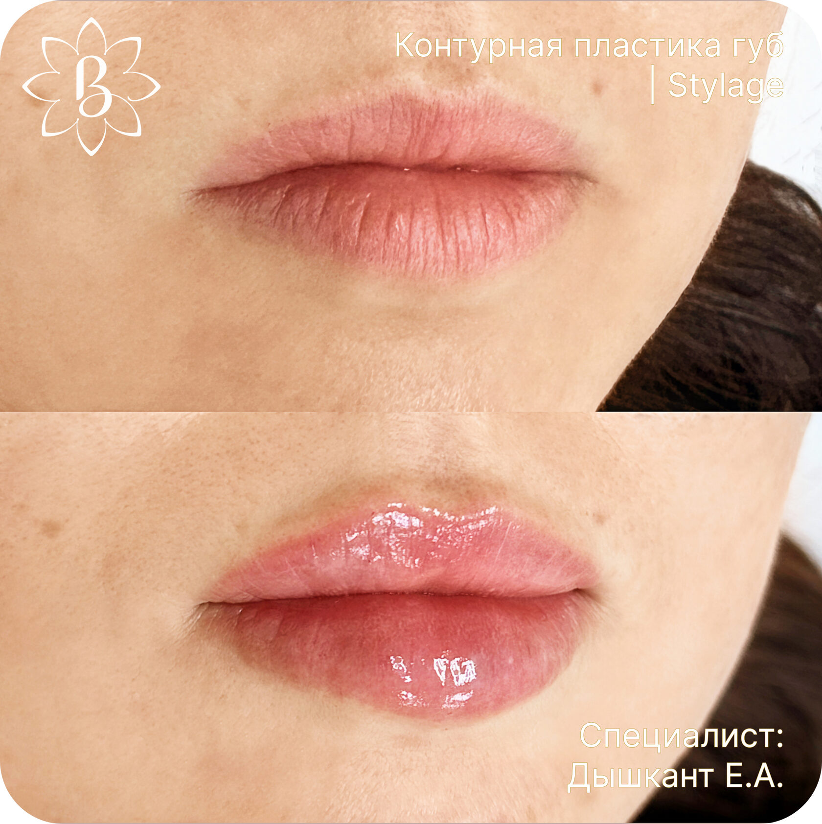 Александритовая лазерная эпиляция СПб