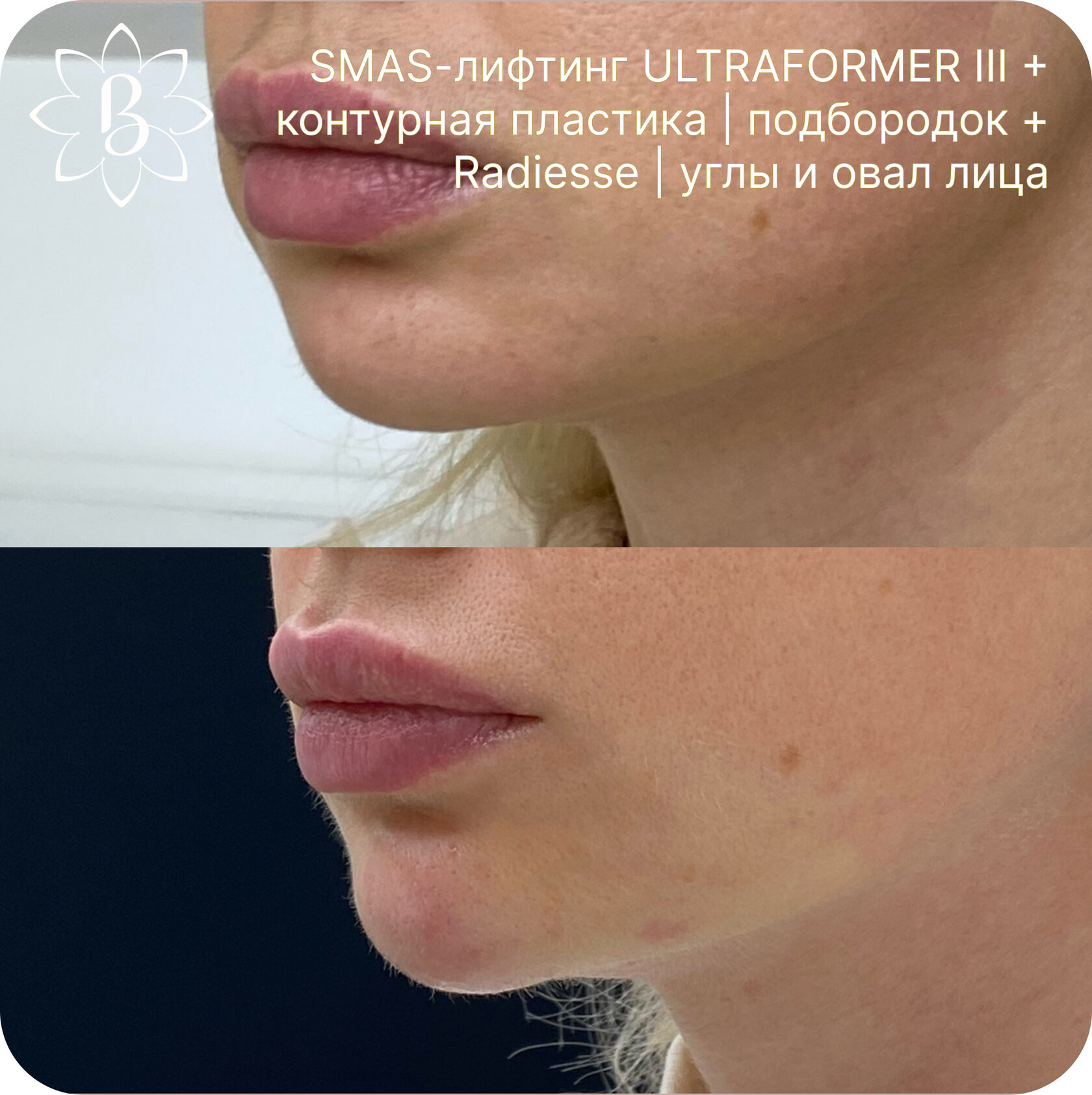 Александритовая лазерная эпиляция