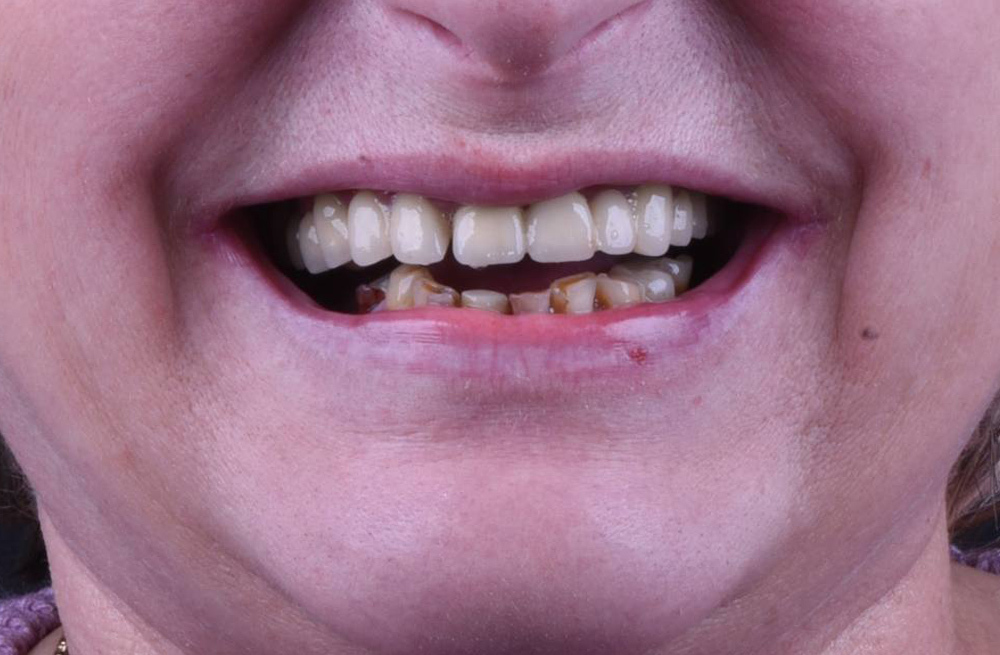 Подготовка к постоянному протезированию – примерка прототипов будущих зубов после остеоинтеграции имплантов