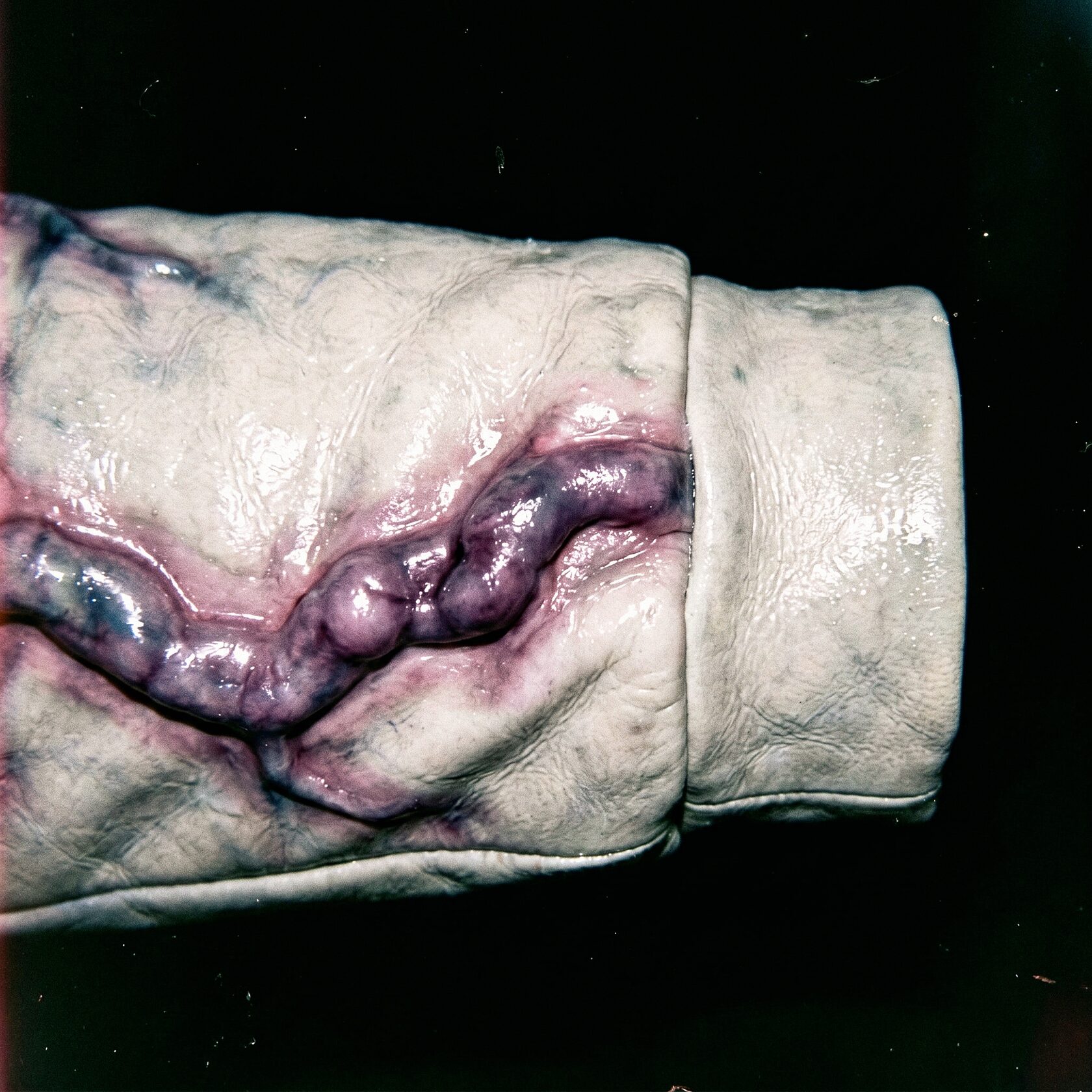 VASCULAR_COLLAPSE