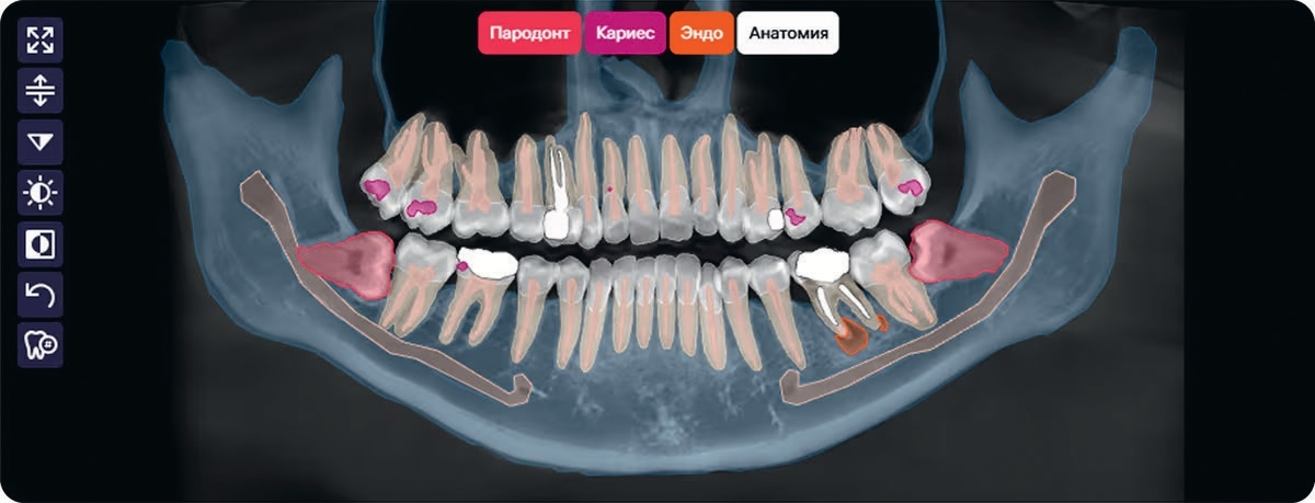Искусственный интеллект Diagnocat