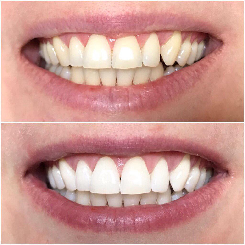Результаты отбеливания зубов электрические зубные щетки эльдорадо oral b