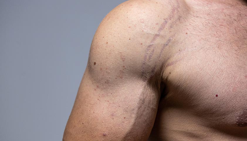 растяжки у мужчин, растяжки на теле у мужчин