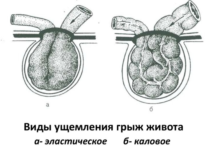 Огромная грыжа фото живота