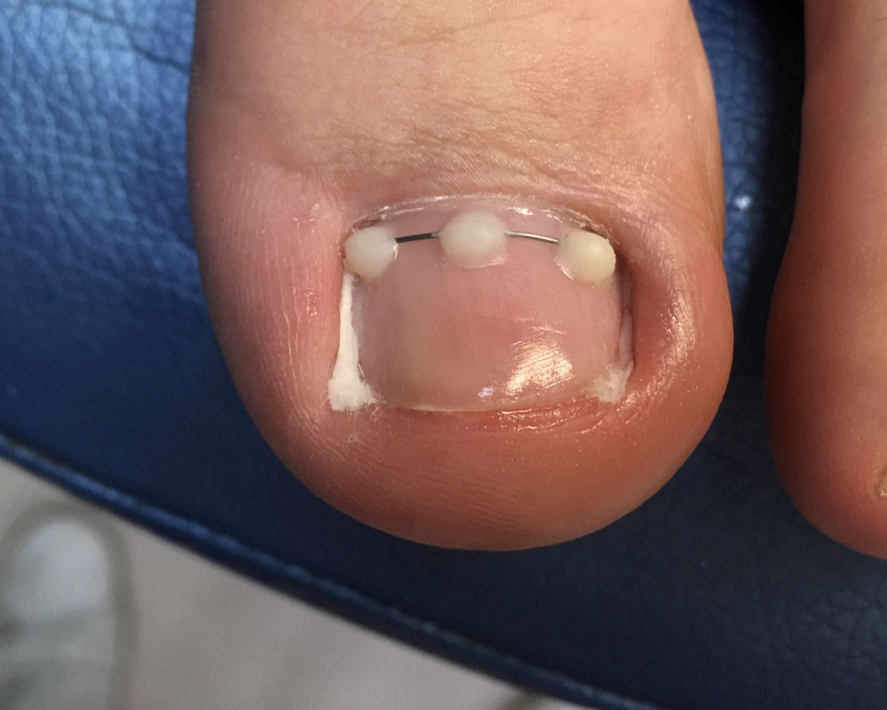 Лечение вросшего ногтя в Нижнем Новгороде ‎Ӏ Прием 1200 руб