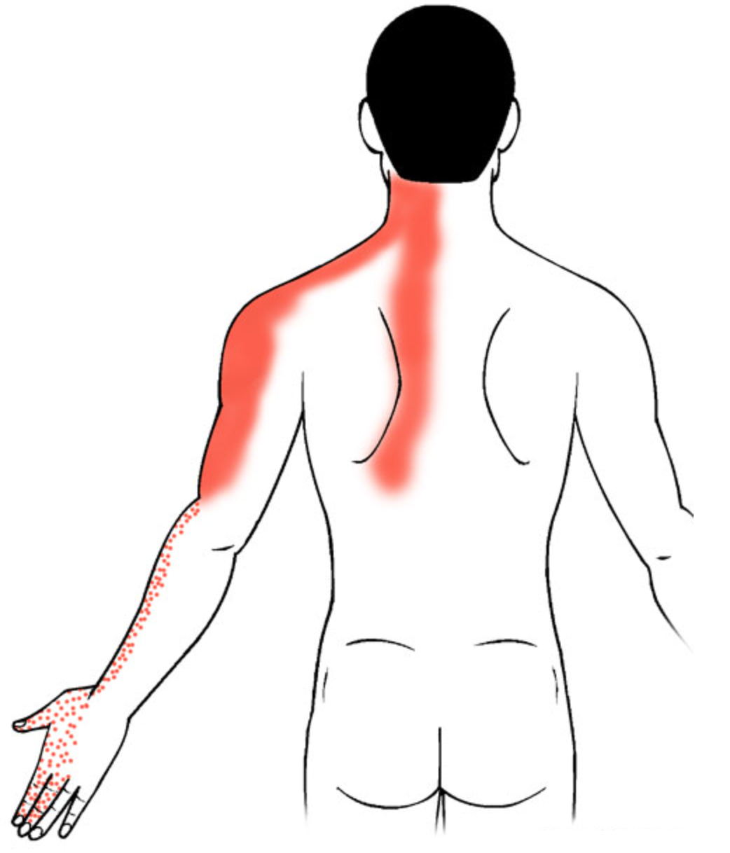 Болит спина отдает в руку. Боли иррадиирующие в левое плечо. Болит левая сторона плечо и рука. Болит спина.