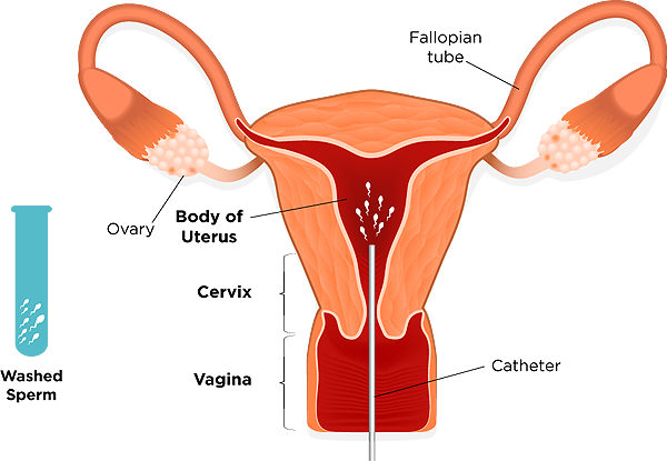 Внутриматочная инсеминация спермой донора – естественное оплодотвоение