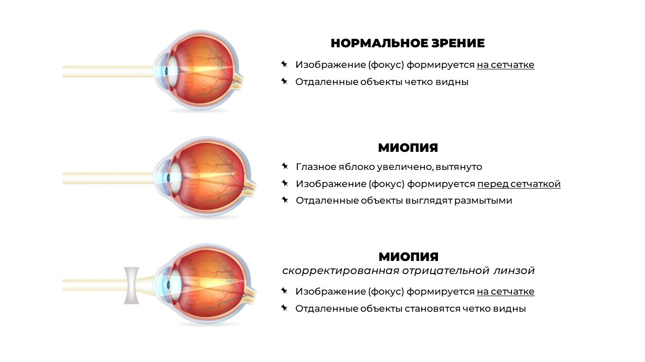 Миопия сетчатки. Сетчатка у близоруких людей. Болезнь близорукость. Близорукость на один глаз. Линзы от миопии.