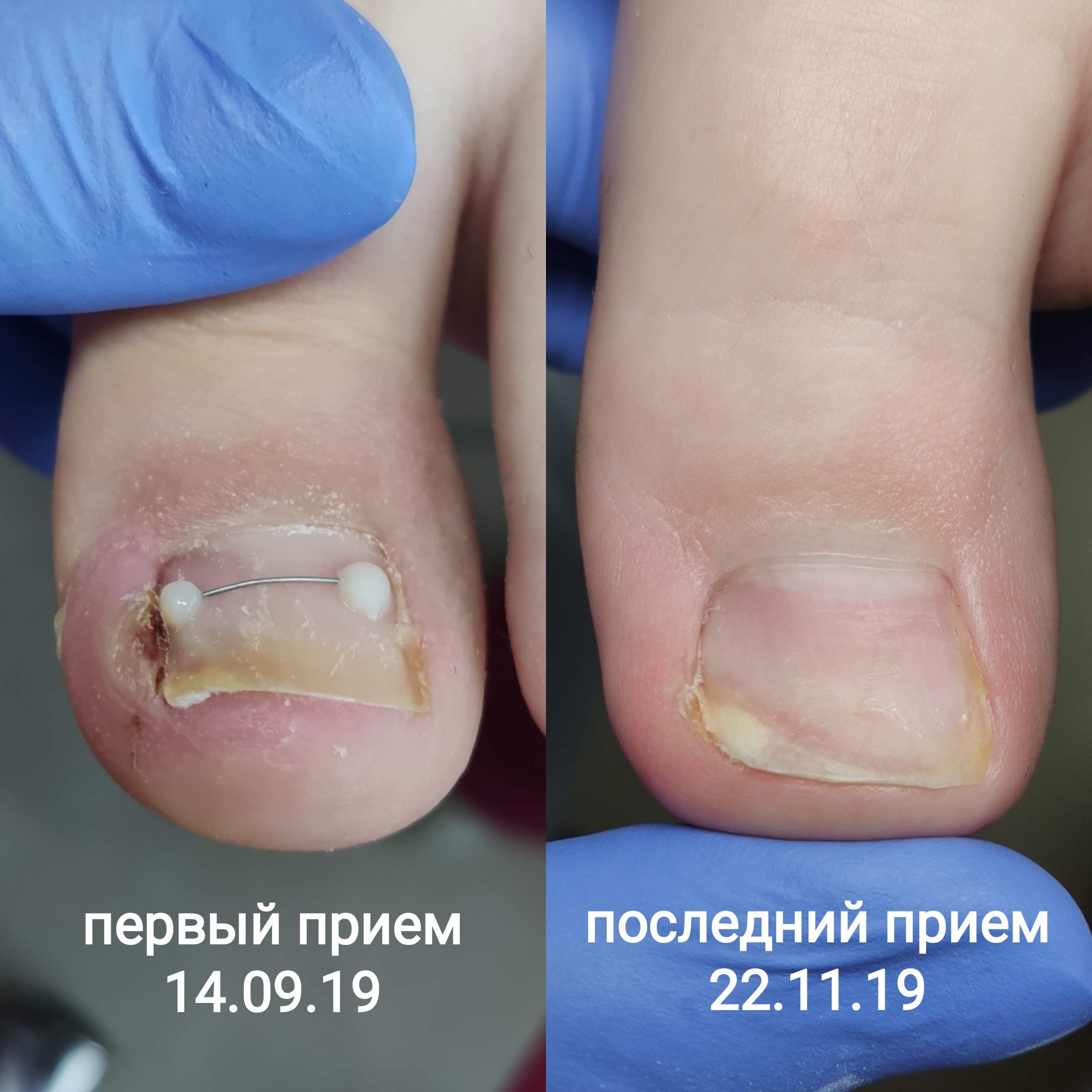 Лечение и удаление вросшего ногтя в Перми без боли по доступной цене ...