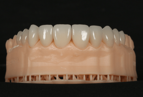 Установка и замена виниров в стоматологической клинике Пробел