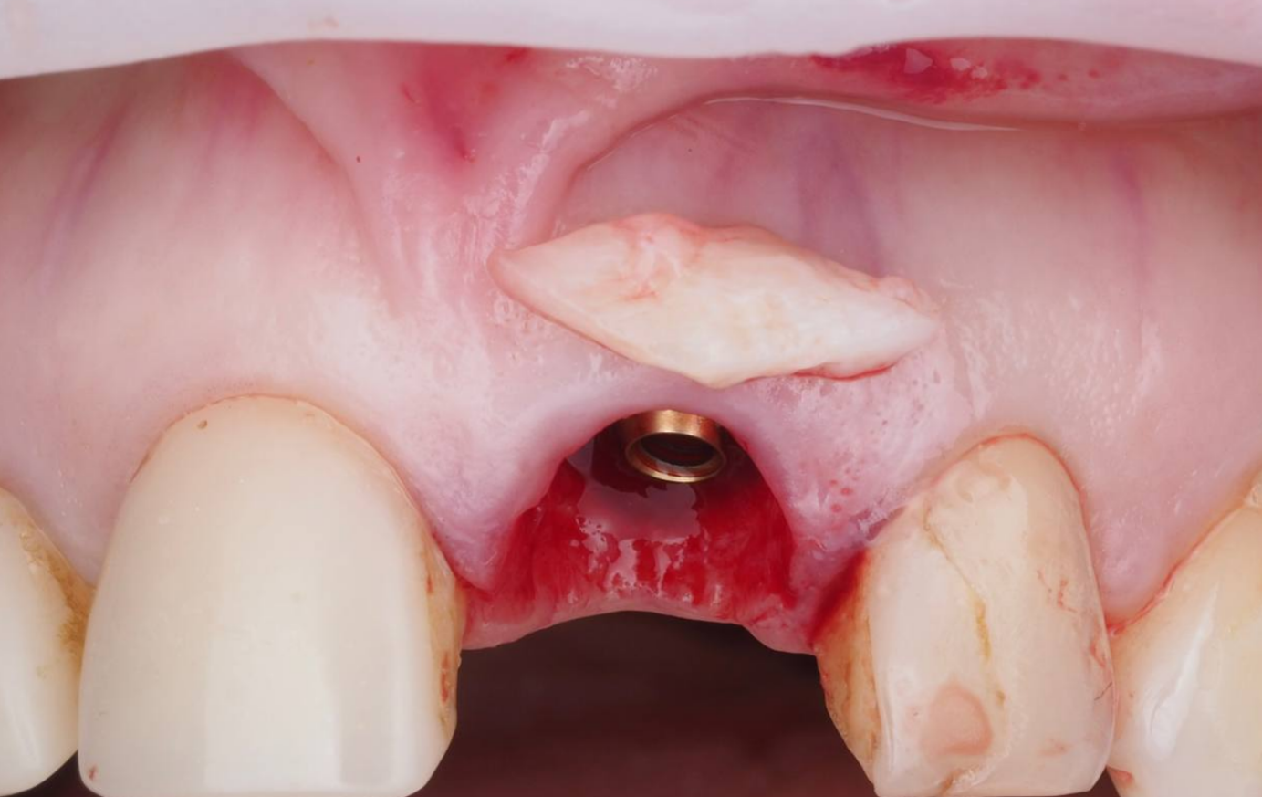Пластика мягких тканей 