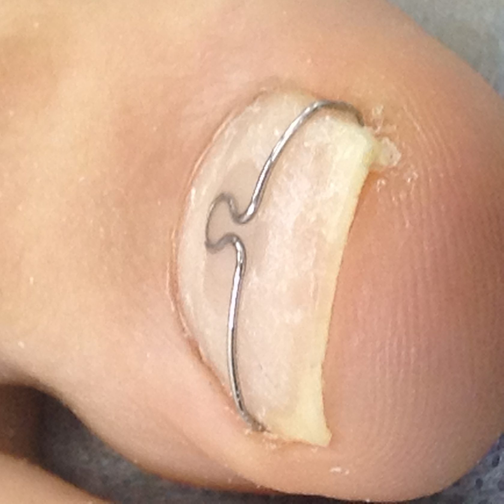 Подология в Курске. Коррекция ногтя.