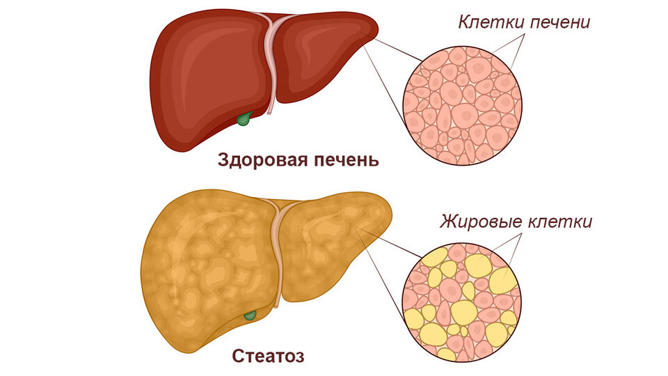 Презентация жировая болезнь печени