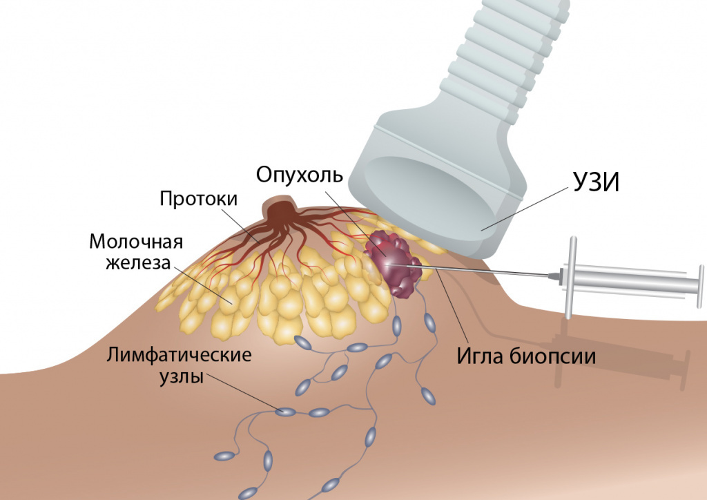 Трепан биопсия что это. Вакуумная аспирационная биопсия молочной железы. Трепан биопсия молочных желез. Тонкоигольная биопсия молочной железы. Тонкоигольная аспирационная пункционная Биопси.