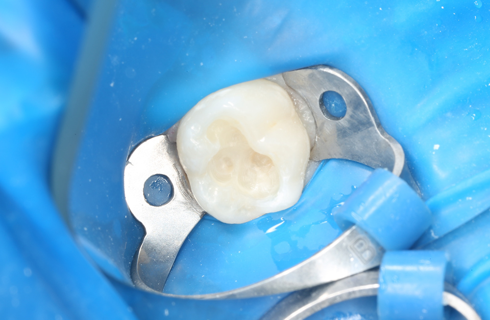 Лечение кариеса дентина молочного зуба с применением композита