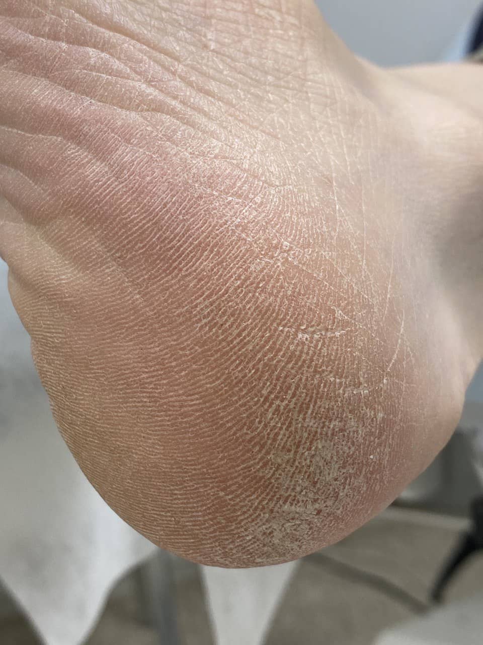 Трещины До глубокие