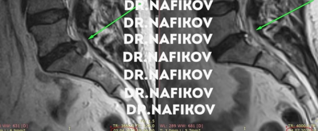 МРТ до и после лечения, Пациент П., 47 лет