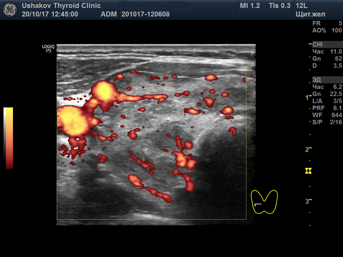 Ti rads щитовидной железы. Ti rads 4. УЗИ, узел левой доли щитовидной железы .ti-rads 4a. Узловой зоб ti-rads 4котегори. Очаговое образование щитовидной железы ti-rads-2.