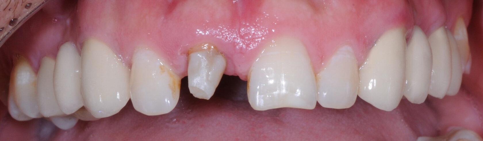 Восстановление резца после травмы с имплантацией Straumann и одномоментным протезированием временной коронкой