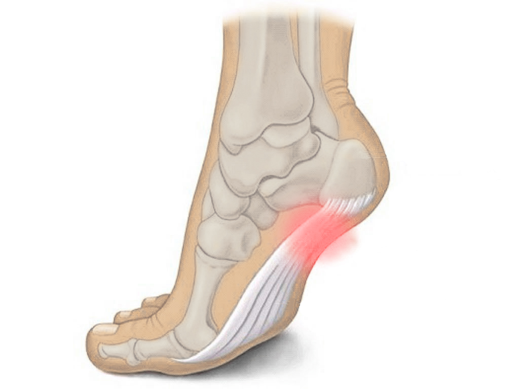 Пяточная шпора (Плантарный фасциит)
