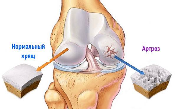 При артрозе коленного сустава боль постоянная или thumbnail