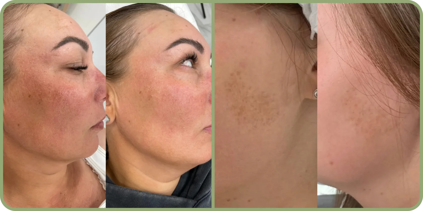 Результат биоревитализации в клинике Uniqderm