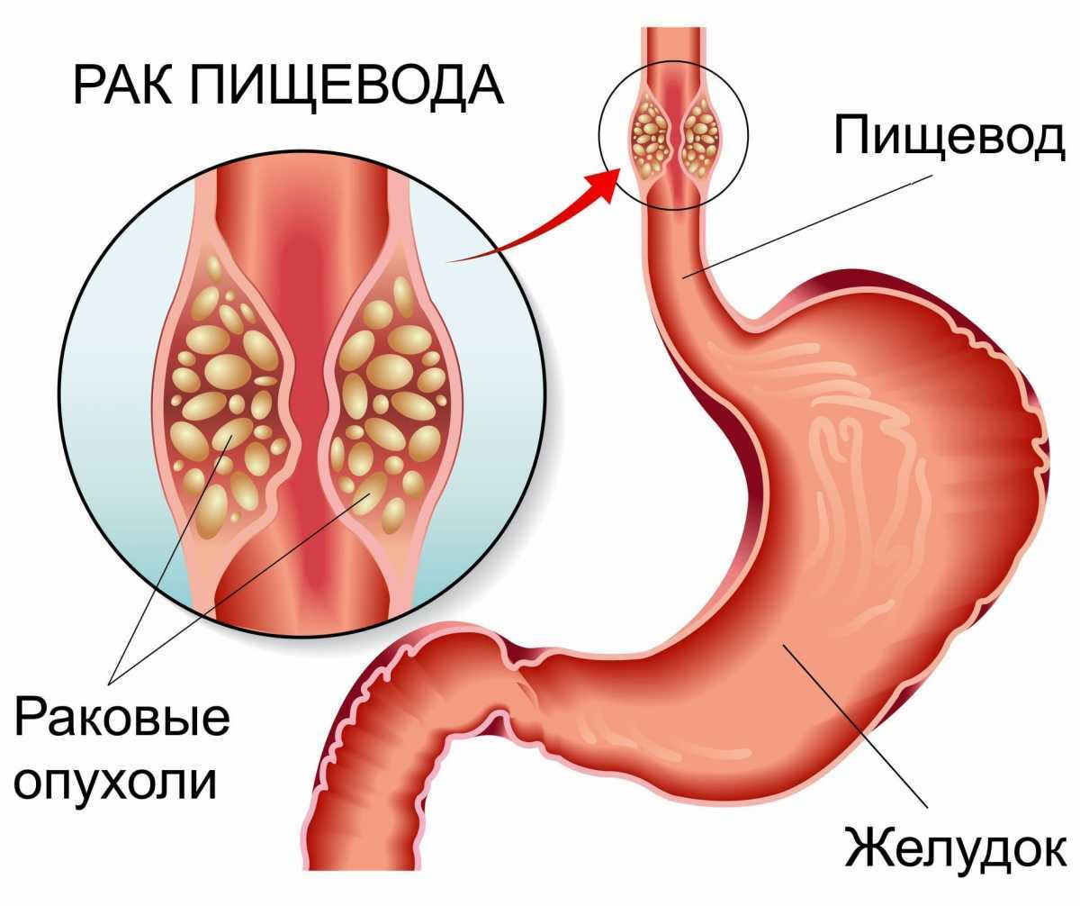 Рак пищевода. Симптомы. Стадии. Типы. Лечение | Центр интегративной медицины