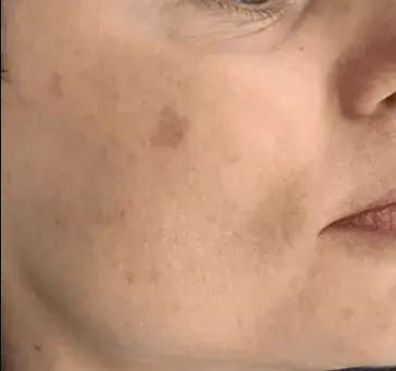 Пигментное пятно на щеке, до