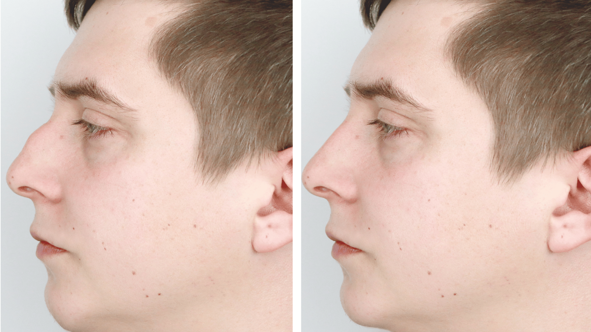 Understanding Male Rhinoplasty: Everything You Need to Know