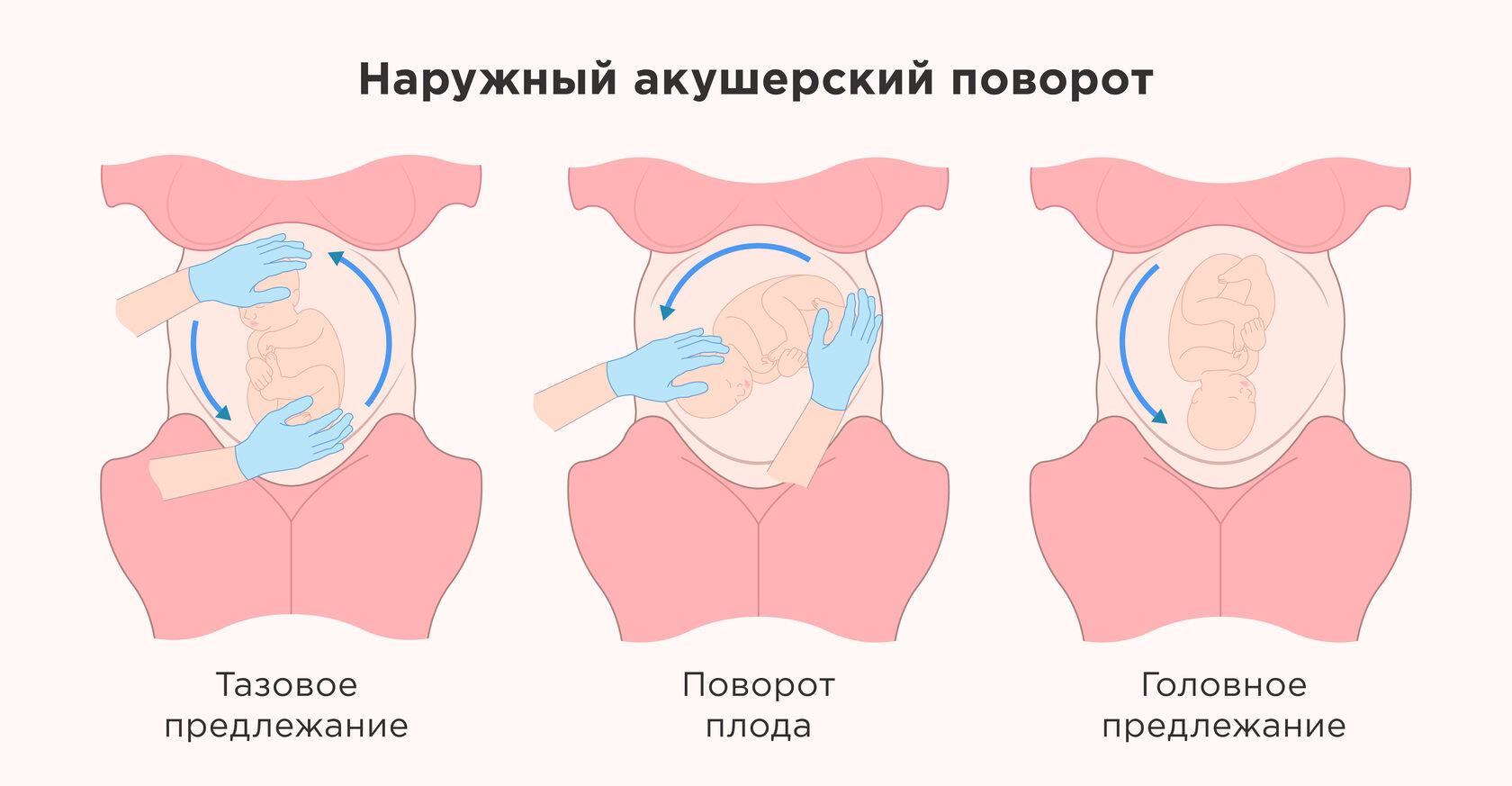 Наружный акушерский поворот плода: кому показан и зачем проводится?