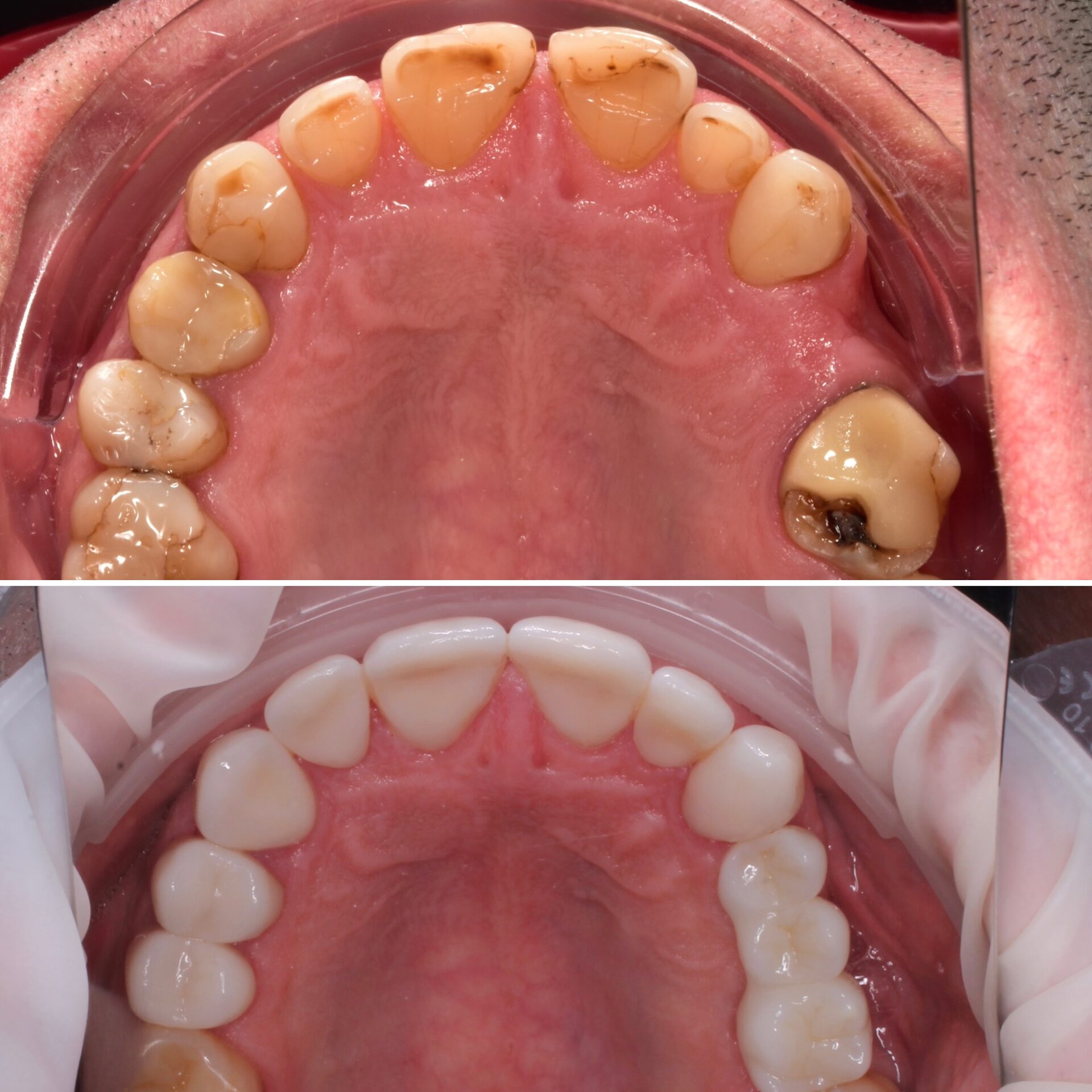 имплантация зубов чебоксары,имплантация зубов йошкар-ола,тотальная реабилитация на 6 имплантатах,протез несъемный в чебоксарах