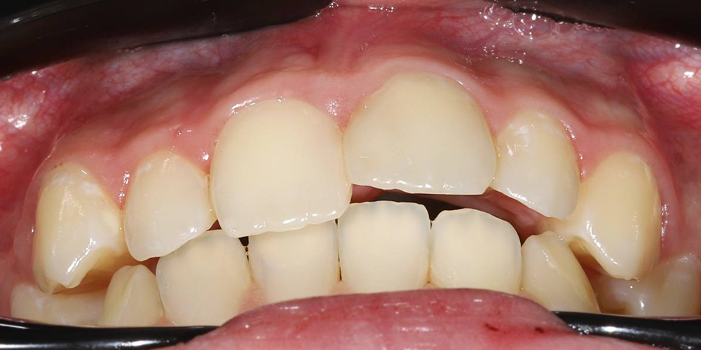 Ортодонтическое лечение брекет-системой Damon Q2 у подростка